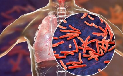 24 martie – Ziua Mondială de Luptă Împotriva Tuberculozei. Mesajul de la Timișoara