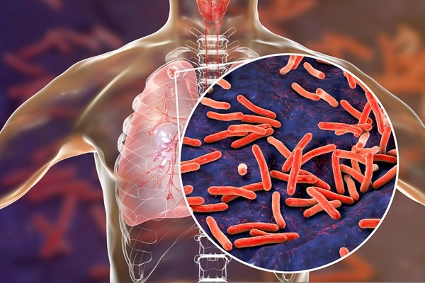 24 martie – Ziua Mondială de Luptă Împotriva Tuberculozei. Mesajul de la Timișoara