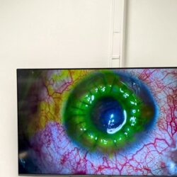 La Timișoara a fost efectuat, în premieră, transplantul de cornee (foto) 2 Încă o premieră medicală aduce Timișoara în atenția oftalmologiei naționale: aici a fost acreditat și operaționalizat singurul centru de transplant cornean din vestul țării