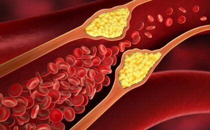 Riscurile unor valori ridicate ale colesterolului din sânge