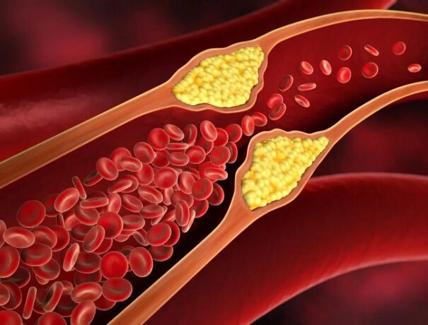 Riscurile unor valori ridicate ale colesterolului din sânge