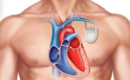 Cum poți face un RMN în siguranță dacă ai un dispozitiv cardiac? Ce spun medicii de la Spitalul Victor Babeș Timișoara