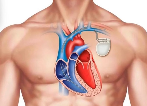Cum poți face un RMN în siguranță dacă ai un dispozitiv cardiac? Ce spun medicii de la Spitalul Victor Babeș Timișoara