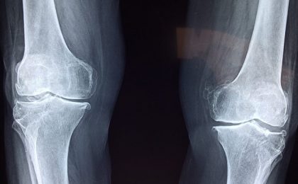 Proteina care blochează dezvoltarea oaselor ar putea oferi indicii pentru viitorul tratament al osteoporozei