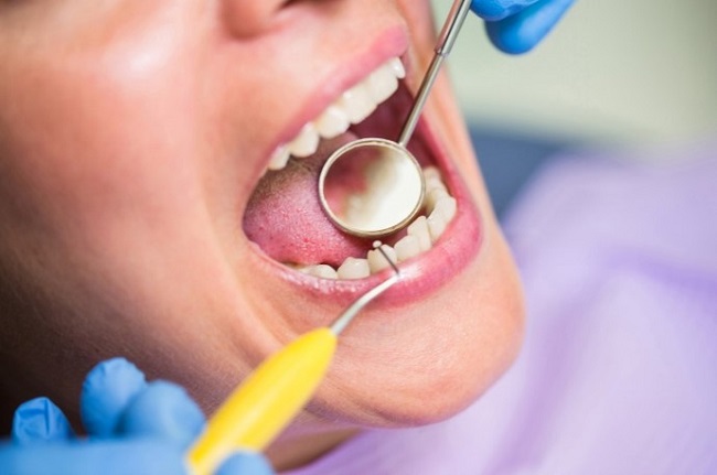 Cauzele petelor dentare și ce poți face pentru a le împiedica